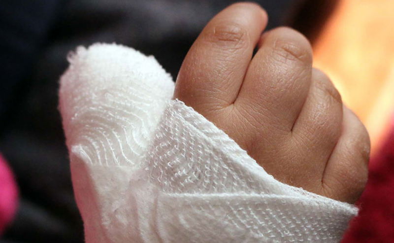 Niña pierde un dedo al tronarle un cohete en la mano