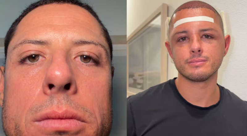 ¿Qué le pasó a Chicharito Hernández? Reaparece con el rostro hinchado