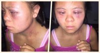Indigna golpiza de padre a su hija con síndomre de Donw; tía denuncia lo denuncia